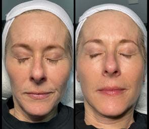 Before and after face treatment with MCC serum