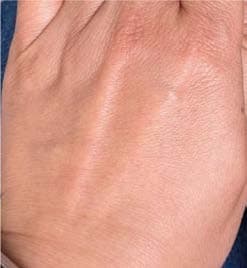 Dorsal hand treated with MCC formulation after 5 days
